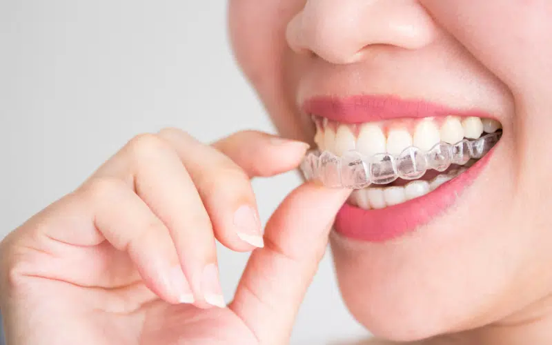 The Considerations While Going For Invisalign in Andover, MA. - the ...